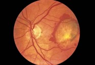 Офталмолозите вече могат да предскажат с точност риска от ослепяване