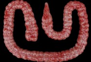Ракът на дебелото черво е лечим, щом се открие навреме