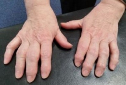 Мъчи ви артрит? Яжте семена от чиа.