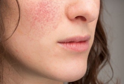 Екземата полезна - пази от рак на кожата 